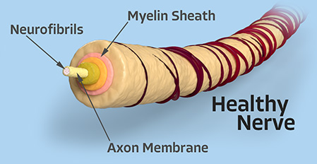 Neuropathy Nerve Damage