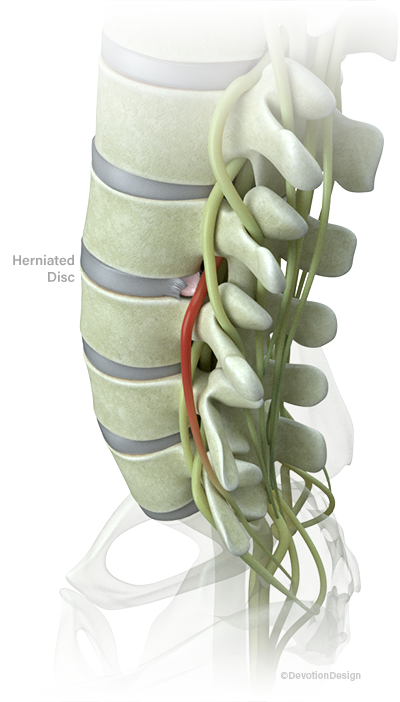 HerniatedDiscTreatment