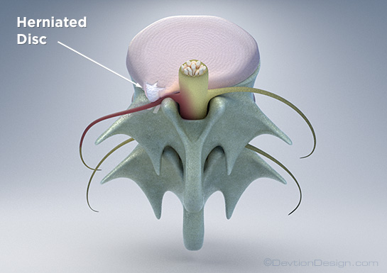 Disc Herniation